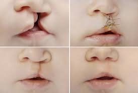 Las hendiduras orofaciales, especialmente el labio hendido, con o sin hendidura de paladar, pueden diagnosticarse durante el embarazo mediante una ecografía de rutina. Todo Sobre El Labio Hendido Y El Paladar Hendido Mejor Con Salud