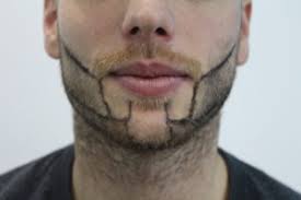 Greffe barbe et moustache technique fue. Greffe De La Barbe 2019 Resultats Video Hlc Experts En Poils De Barbe