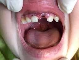 Image result for Tooth Avulsion
