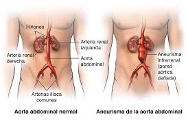 Nuestros expertos han respondido 3 preguntas sobre aneurisma de la aorta torácica. Abdominal Aortic Aneurysm