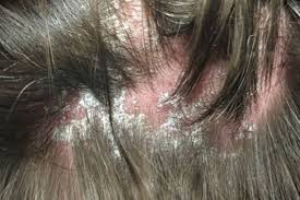 Hair loss scalp psoriasisitself doesn't cause hair loss, but scratching a lot or very hard, picking at the scaly spots, harsh treatments, and the stressthat goes along with the condition can lead. Can Psoriasis Also Cause Scarring Donovan Hair Clinic