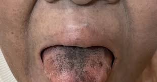 Image result for black tongue symptoms