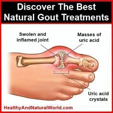 Gout Is A Complex Form Of Arthritis And Can Be Very Painful And Cause A Great Discomfort It Often Affects Gout Treatment Natural Gout Treatment Gout Remedies