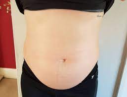 Woman Has Huge Ovarian Cyst Removed After Gym Instructor Asked If She S Pregnant Swns