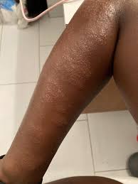 Image result for polymorphous eruption