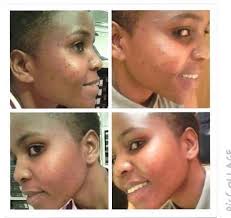 Btw, make sure you always conduct a patch test for sensitivity before applying these homemade natural remedies on your entire face. 7 Day Herbalife Skin Care Products Nuevo Skincare