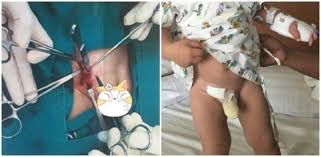 Penyakit angin pasang yang tidak dirawat boleh menyebabkan komplikasi yang lebih serius. Hernia Pada Bayi Ketahui Tanda Tanda Hernia Sebelum Terlambat
