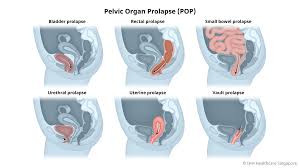 Image result for Urethral Prolapse