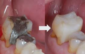 To get to the core of the tooth to remove the infection. Fillings And Root Canal Treatment Leicester Willowbrook Dental
