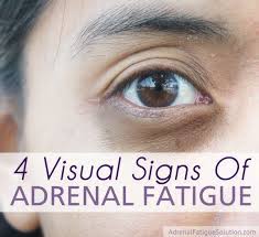 Proponents of the adrenal fatigue diagnosis claim this is a mild form of adrenal insufficiency caused by chronic stress. 4 Visual Signs That You Could Have Adrenal Fatigue