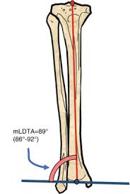 Epiphyseal disc • in the embryo and the growing child it is a cartilaginous plate located between the epiphysis and the. Frontal Plane Deformities And Drawing Axes Of The Long Bones Springerlink