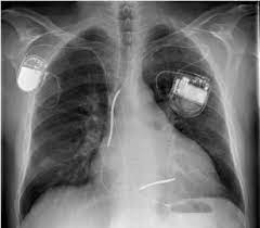 By sorin lazar, henry huang and erik wissner. Chest X Ray Pa Male Patient Vvir Pacemaker On The Right Side Philos Download Scientific Diagram