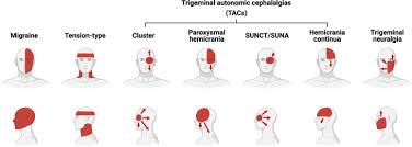 Image result for Acute Localized Headache