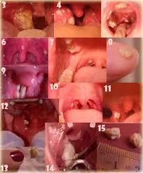 Image result for tonsil stones