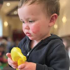 Parents afraid to cuddle son for fear of hurting him due to rare skin  condition