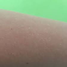 Kleine Weisse Flecken An Den Armen Haut Arm Weisse Flecken