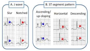 Nella pericardite acuta l'ecg mostra sopralivellamento del tratto st, generalmente a concavità superiore, nelle derivazioni con qrs positivo. Anmco Associazione Nazionale Medici Cardiologi Ospedalieri