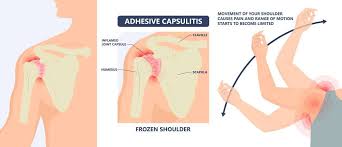 Image result for Frozen Shoulder