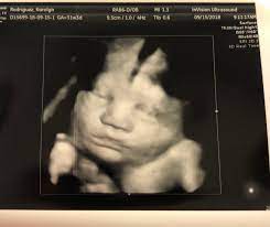 3d 4d Ultrasound At 31 Weeks November 2018 Babies Forums What To Expect