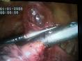 Pneumotorace - 