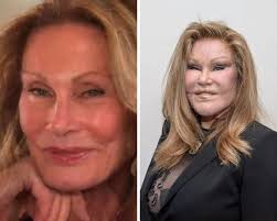 A wave of chaos has erupted after a Beverly Hills plastic surgeon allegedly  revealed rare, unedited photos of Meghan Markle that show a dramatically  altered appearance many are calling her “Ozempic look.”