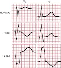 Image result for Right Bundle Branch Block