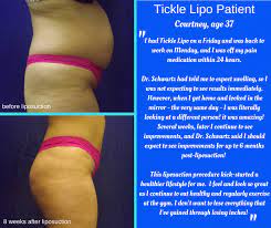 Industry guidelines dictate that a single liposuction session shouldn't remove more than a gallon (roughly 11 pounds) of fat. Will Liposuction Help Me Lose Weight Kansas City Liposuction Premier Vein And Body By Schwartz