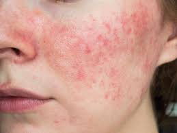 Image result for acne face