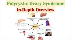 It is a leading cause of female infertility and is responsible for a. Polycystic Ovary Syndrome Pcos Overview Of Associated Conditions Diagnosis Treatments Youtube