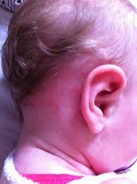 Dreitagefieber September 2012 Kinder Eltern Babycenter