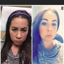 JAMES E. VOGEL, MD, FACS