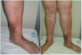 Image result for Lipodermatosclerosis