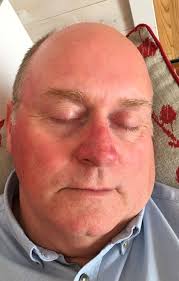Imiquimod topical (for the skin, aldara 5% 250mg) is used totreat actinic keratosis (a condition caused by too much sun exposure) on the face and scalp. Grandad Hails 12 50 Miracle Cream That Transforms Skin After Cancer Treatment Mirror Online