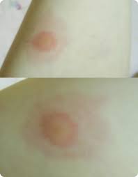 See full list on miyakyo0001.com èšŠã‚¢ãƒ¬ãƒ«ã‚®ãƒ¼ Db