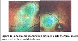 Stage 4, or metastatic breast cancer, occurs when cancer spreads to other organs or bones. Choroidal Metastasis As A First Sign Of Recurrence In A Patient With Breast Cancer A Case Report