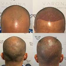 Quick Fue Healing Hair Restoration Surgery Hair Restoration Hair Transplant