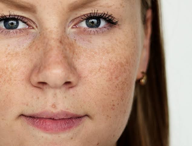 Pigmentation Treatment in Dubai