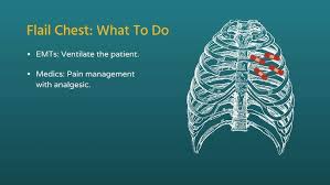 Image result for Flail Chest