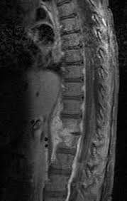 Image result for Spinal Infection