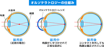 手術なしで視力回復 次世代コンタクトレンズ オルソケラトロジー とは Eyepedia