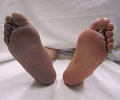 To affect with thrombosis a thrombosed blood vessel. Thrombosis Wikipedia