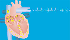 Image result for Atrial Fibrillation