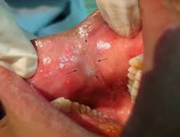 Image result for granuloma gum disease
