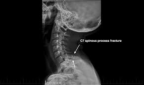 In 78% of transverse process fractures, ct scanning showed that the fracture extended into the transverse foramen. Radiology Review C7 Spinous Process Fracture Axis Sports Med