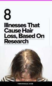 8 Illnesses That Cause Hair Loss Based On Research Hair Loss Treatment Natural Hair Loss Treatment Alopecia Treatment
