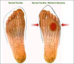 Corticosteroid Injections Are Often Used To Treat Morton S Neuroma If They Fail We Treat Mortons Neuroma Wi Neuroma Morton S Neuroma Mortons Neuroma Treatment