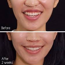 How to fix a gummy smile with lip fillers. Smile Gummy Smile Lip Filler