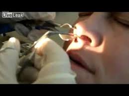 Webmd explains nasal polyps, including what causes them, their symptoms, and their treatment. Doctor Removes Booger From Hell From Inside Man S Nose Youtube
