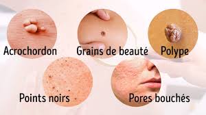 8 Maladies Graves Que Notre Peau Nous Signale Molluscum Pendulum Grain De Beaute Visage Tache Visage