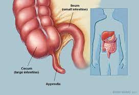 Appendix Picture Image On Medicinenet Com